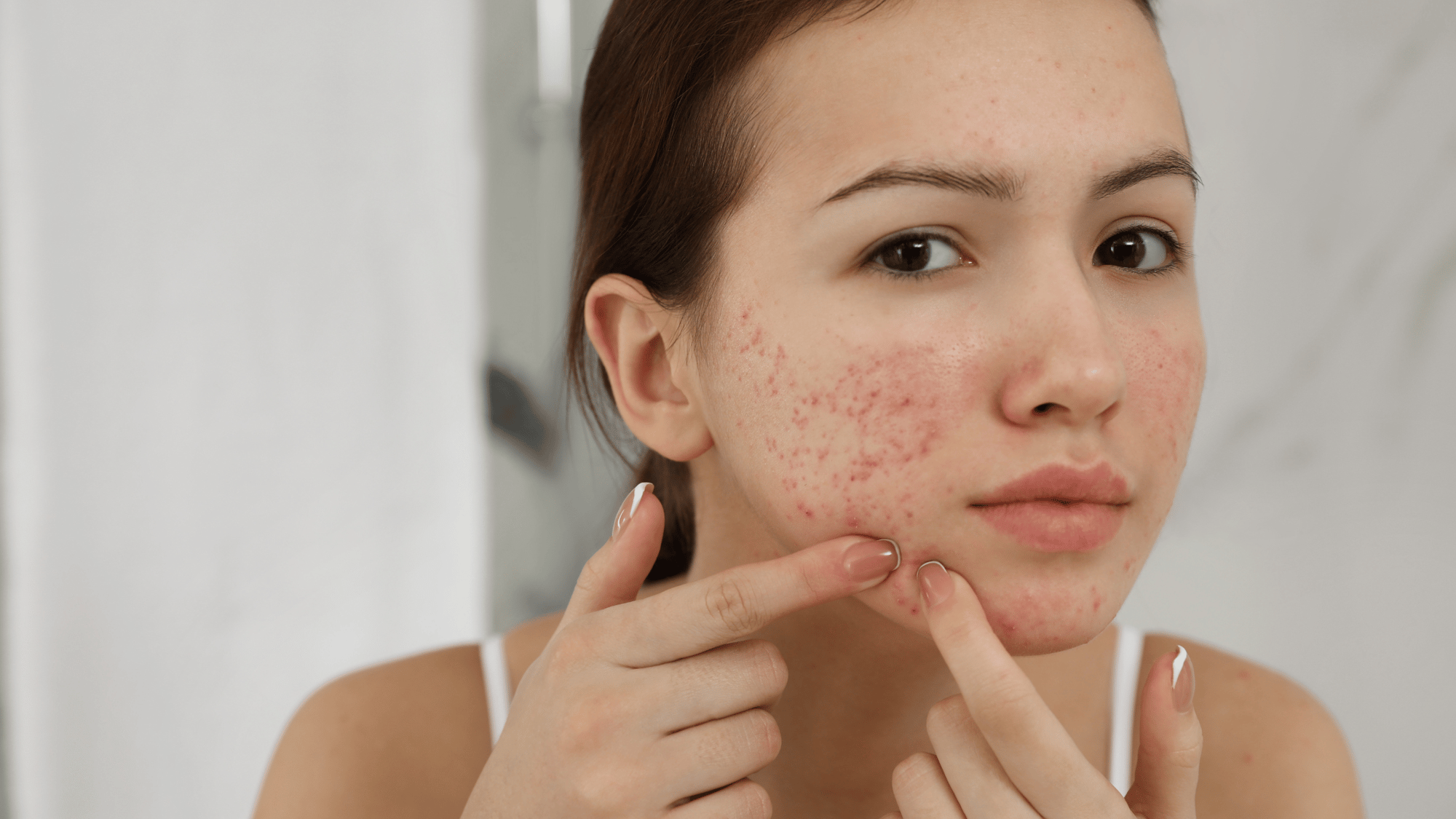 young woman examining her acne