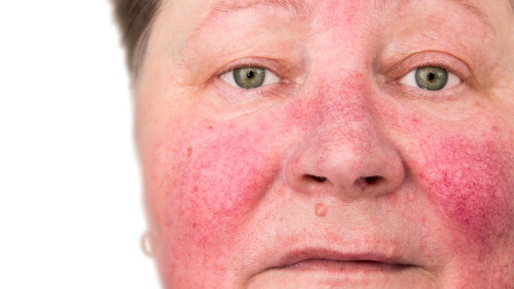 Woman with rosacea