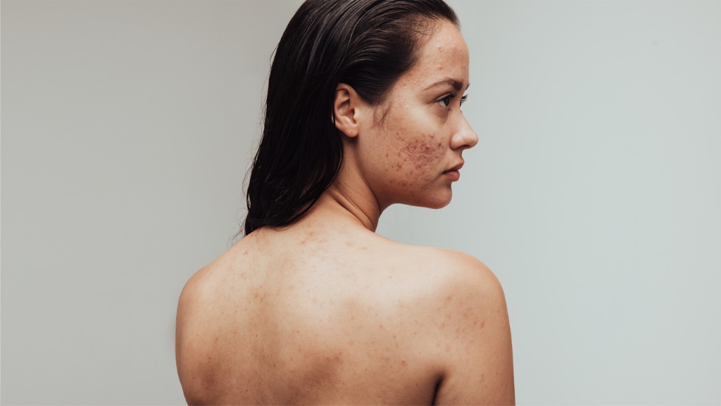 woman with acne