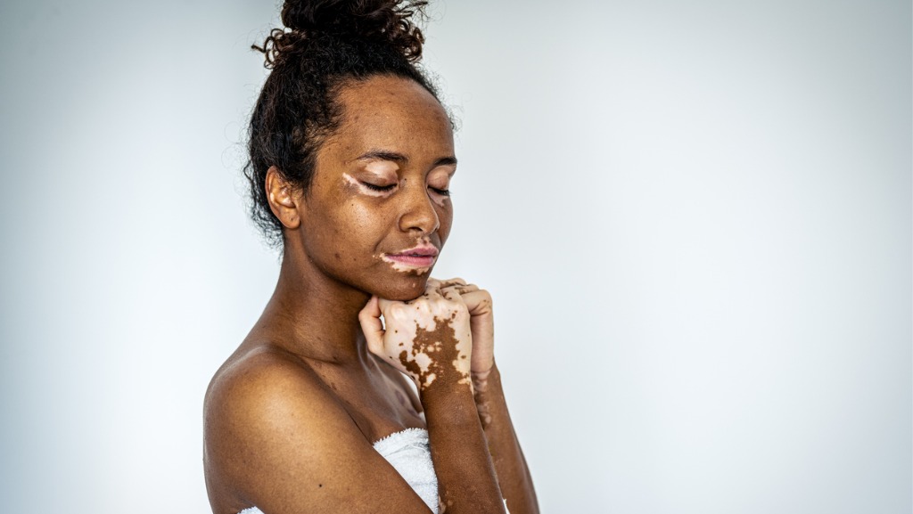 woman with vitiligo
