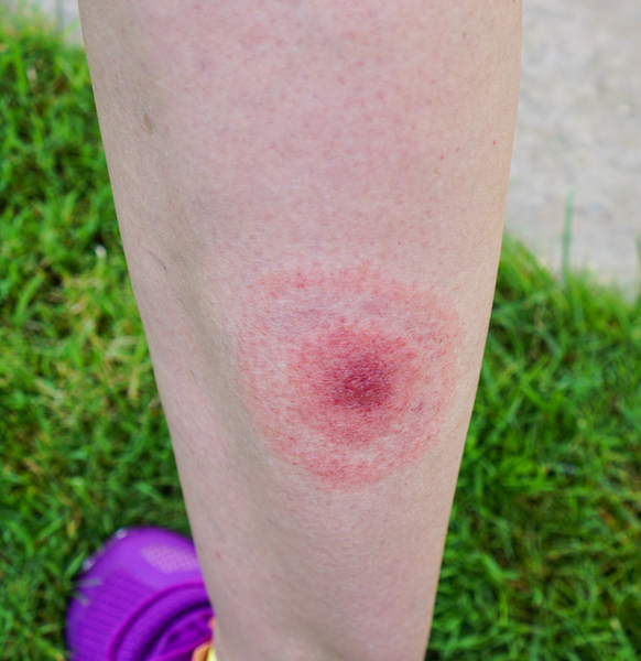 Bullseye rash from a blacklegged tick or deer tick bite, often symptomatic of Lyme Disease